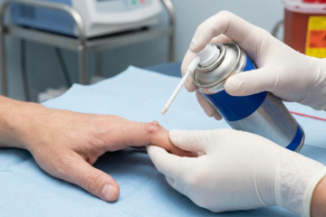 Skin Care Cryosurgery